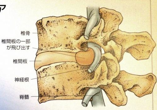 椎間板　解剖学　後屈　腰痛